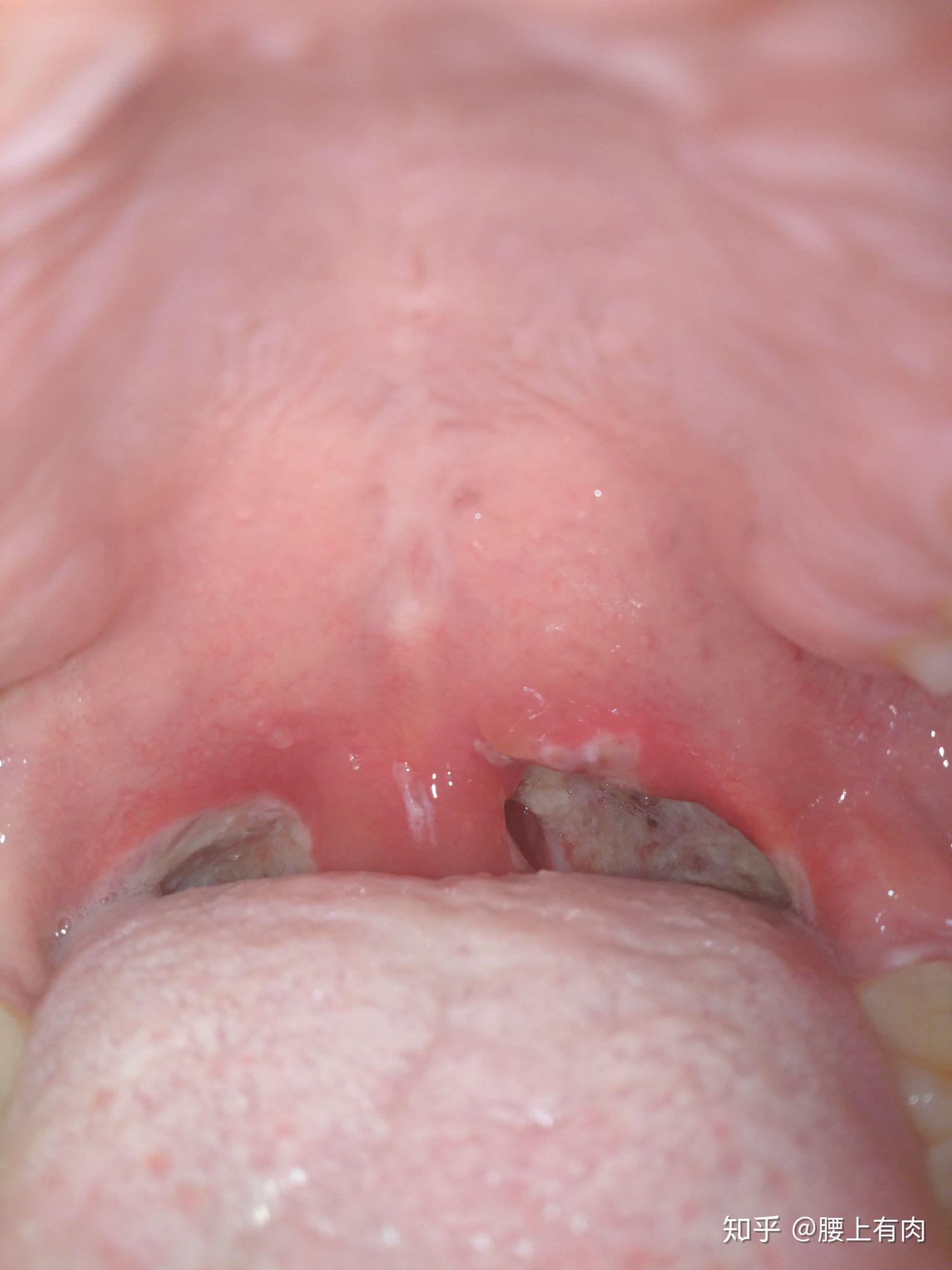 切扁桃体之后是什么感觉