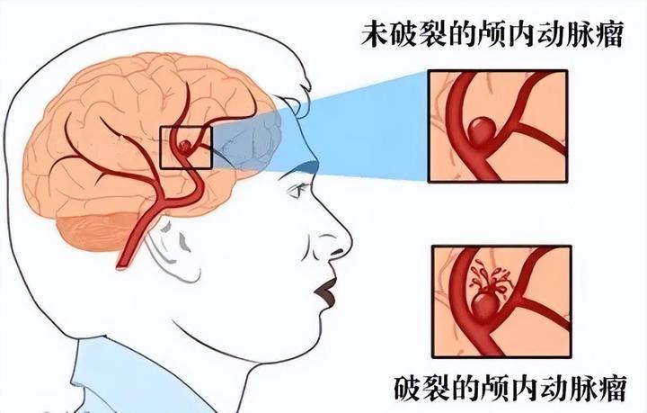 此瘤非彼瘤，随时会引爆！如何尽早发现脑动脉瘤，正确面对脑动脉瘤- 知乎