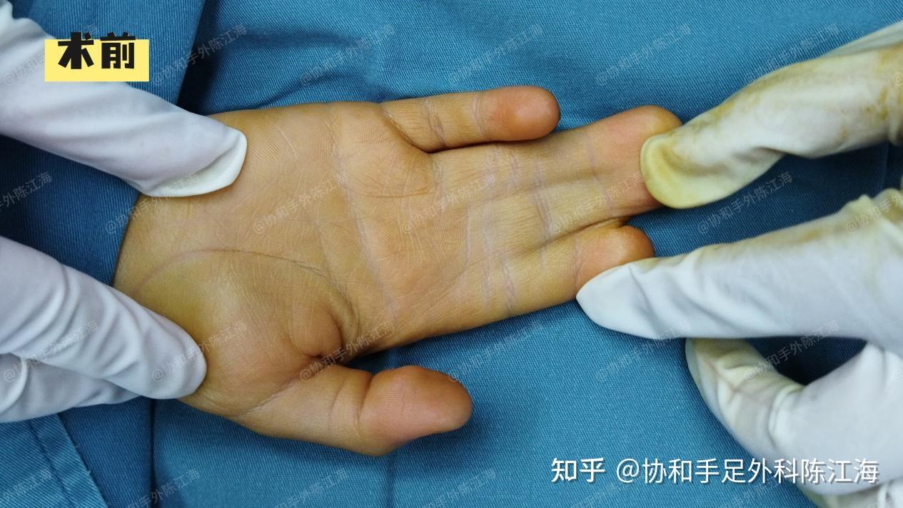并指免植皮 | 案例20 双手并指一次分开,写字、做游戏都很灵活 - 知乎