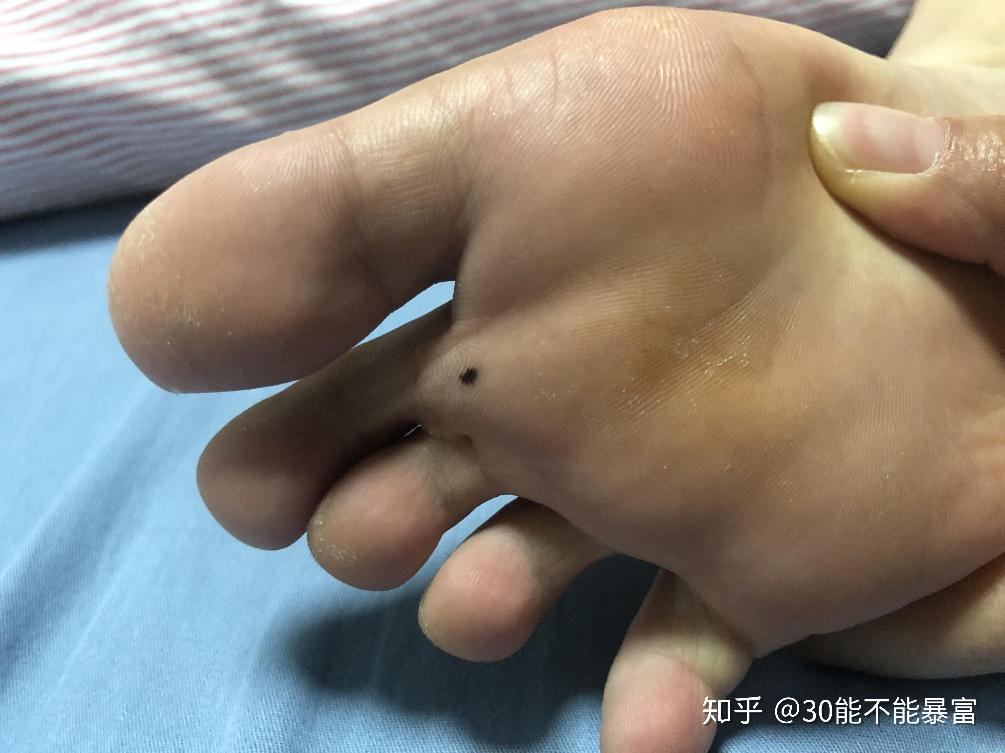 脚底板长了一颗痣