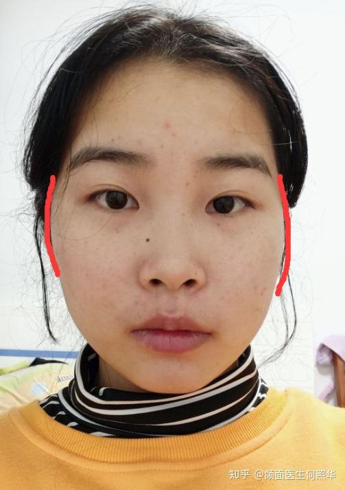 左右脸不对称有什么方法可以改善
