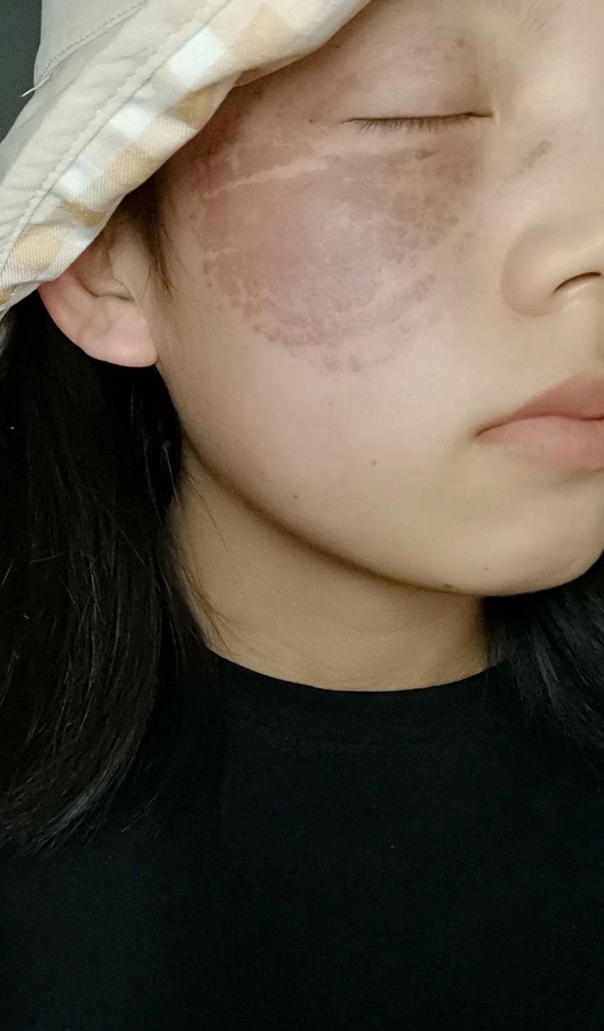 太田痣激光手术后几天可以见人呢