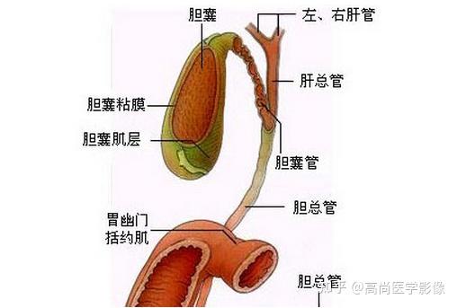 60歲女性膽結石肝內膽管膽總管結石膽囊炎必須切除膽囊嗎