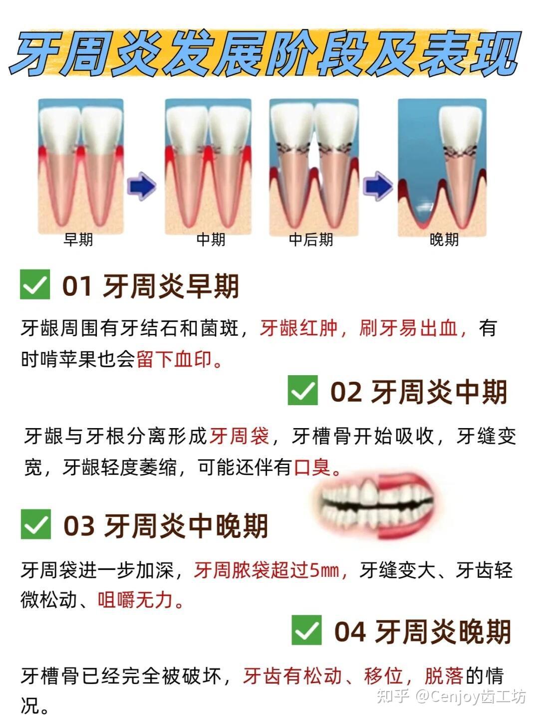 牙周炎、牙龈萎缩怎么办? - 知乎