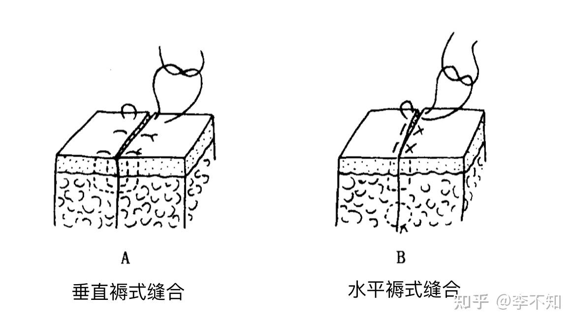 垂直褥式缝合和水平褥式缝合中的垂直和水平分别代表什么意思