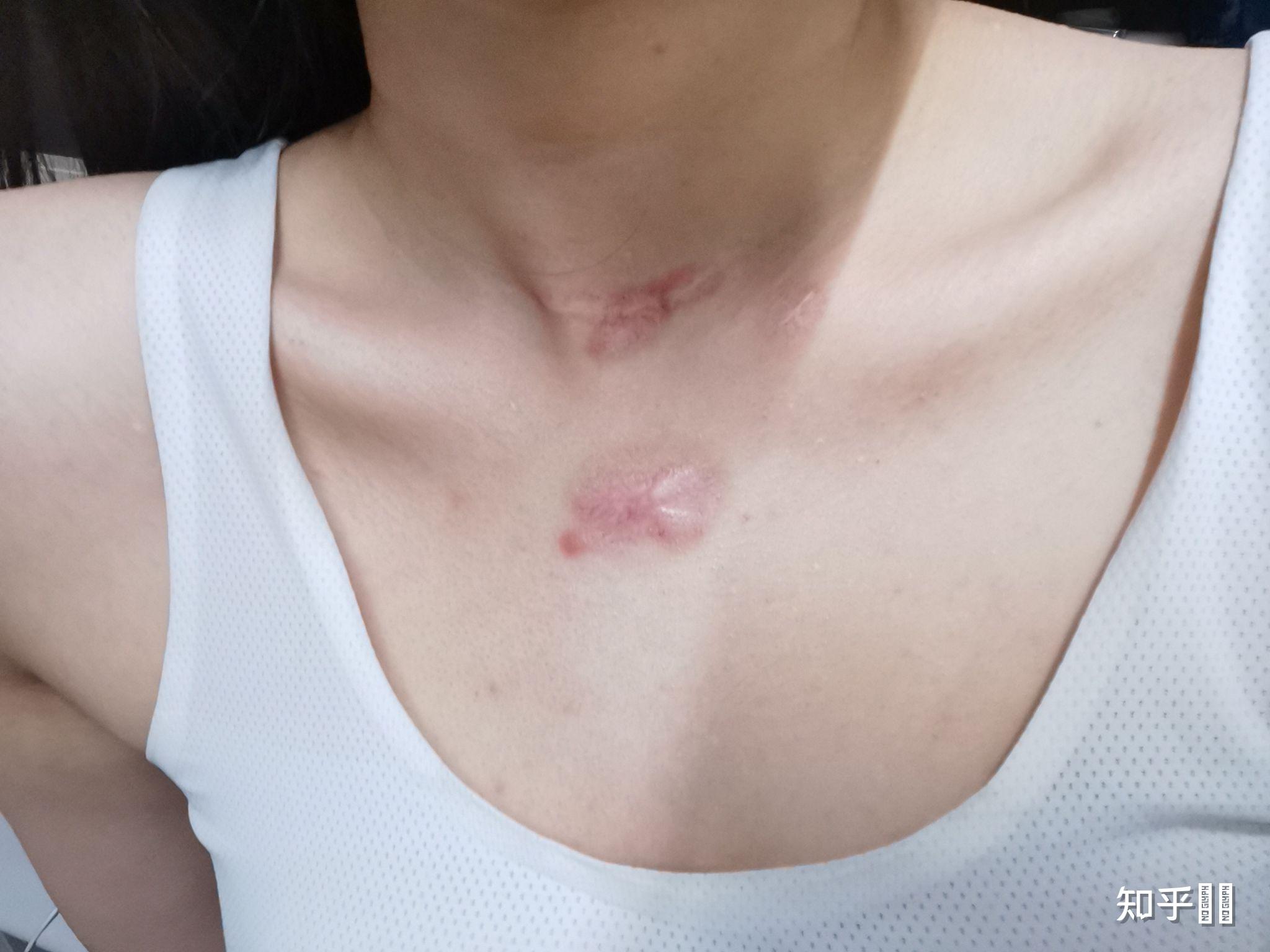 怎么快速去除增生疤痕? - 知乎