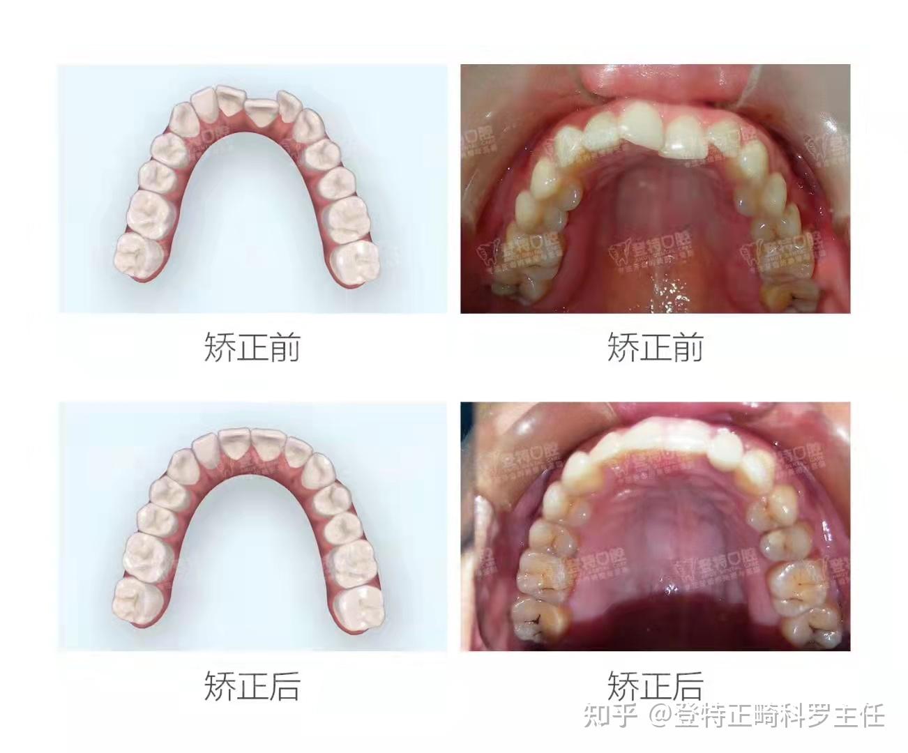 口扫是不是很方便,用口扫都有哪些好处呢? - 知乎