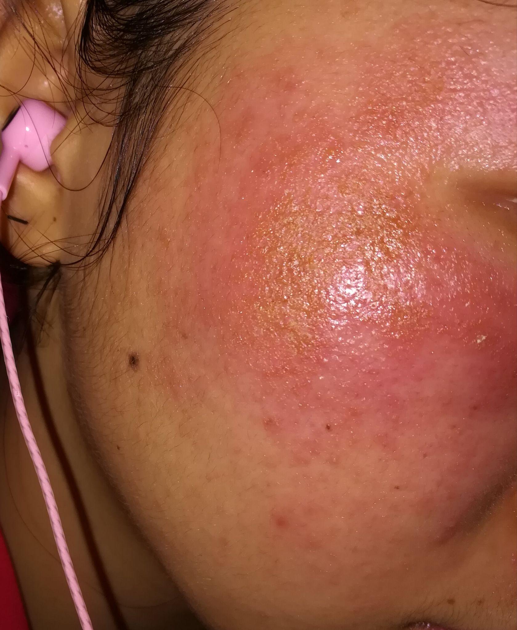 皮肤发生过敏时,该怎么急救? - 知乎