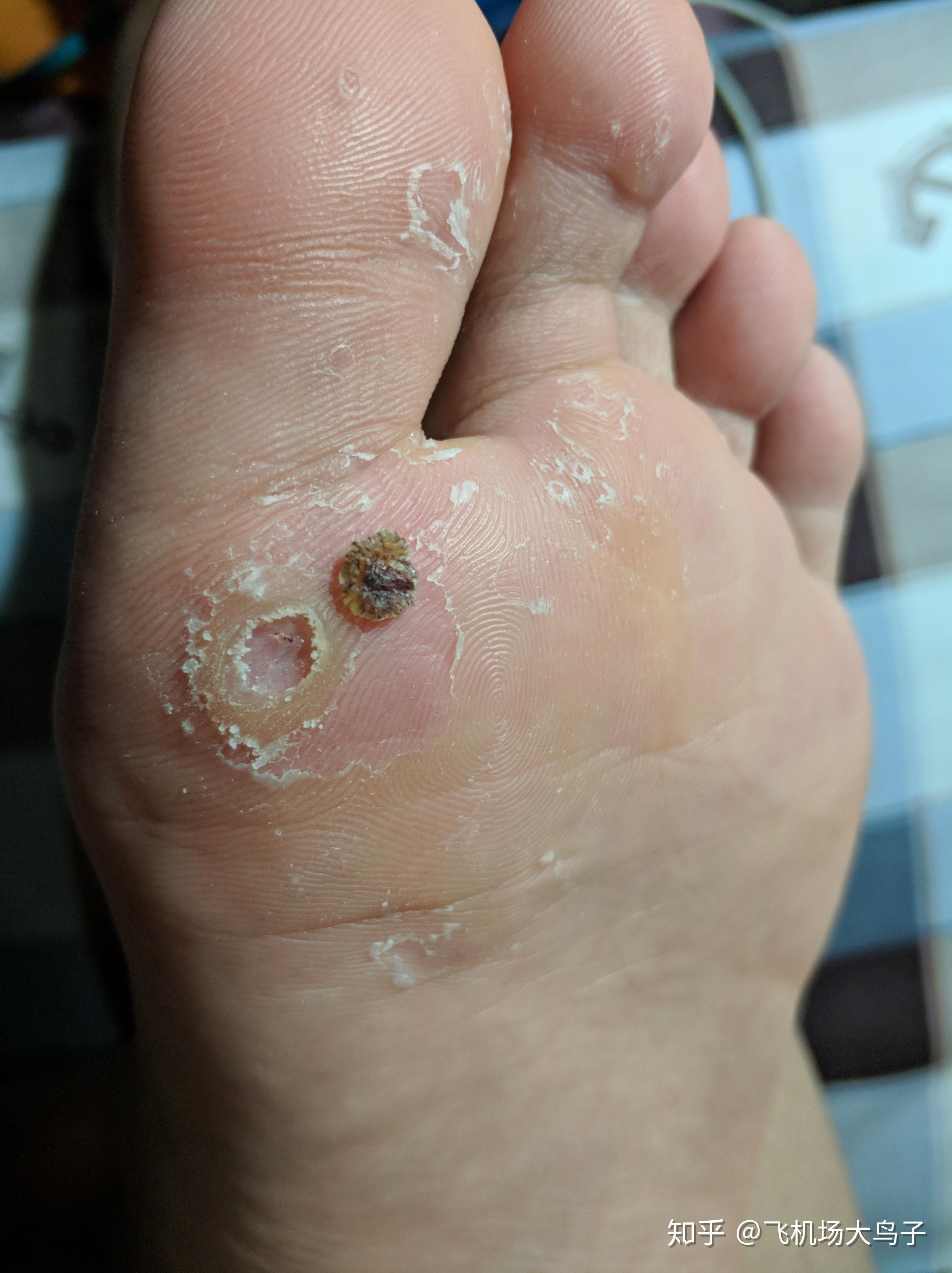 跖疣如何治疗? - 知乎