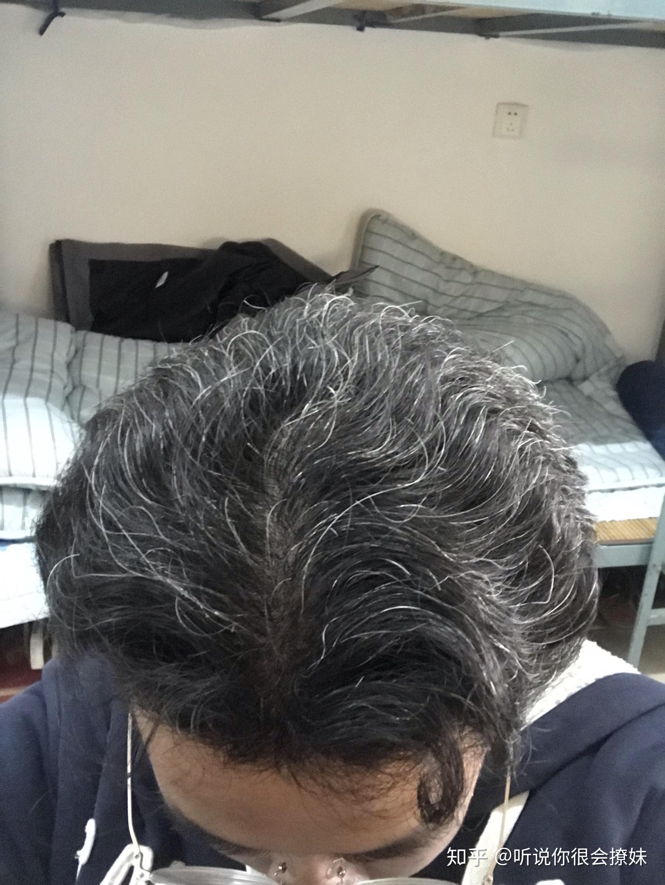女生少白头严重白头发一大半很烦恼自卑平时染发告诉