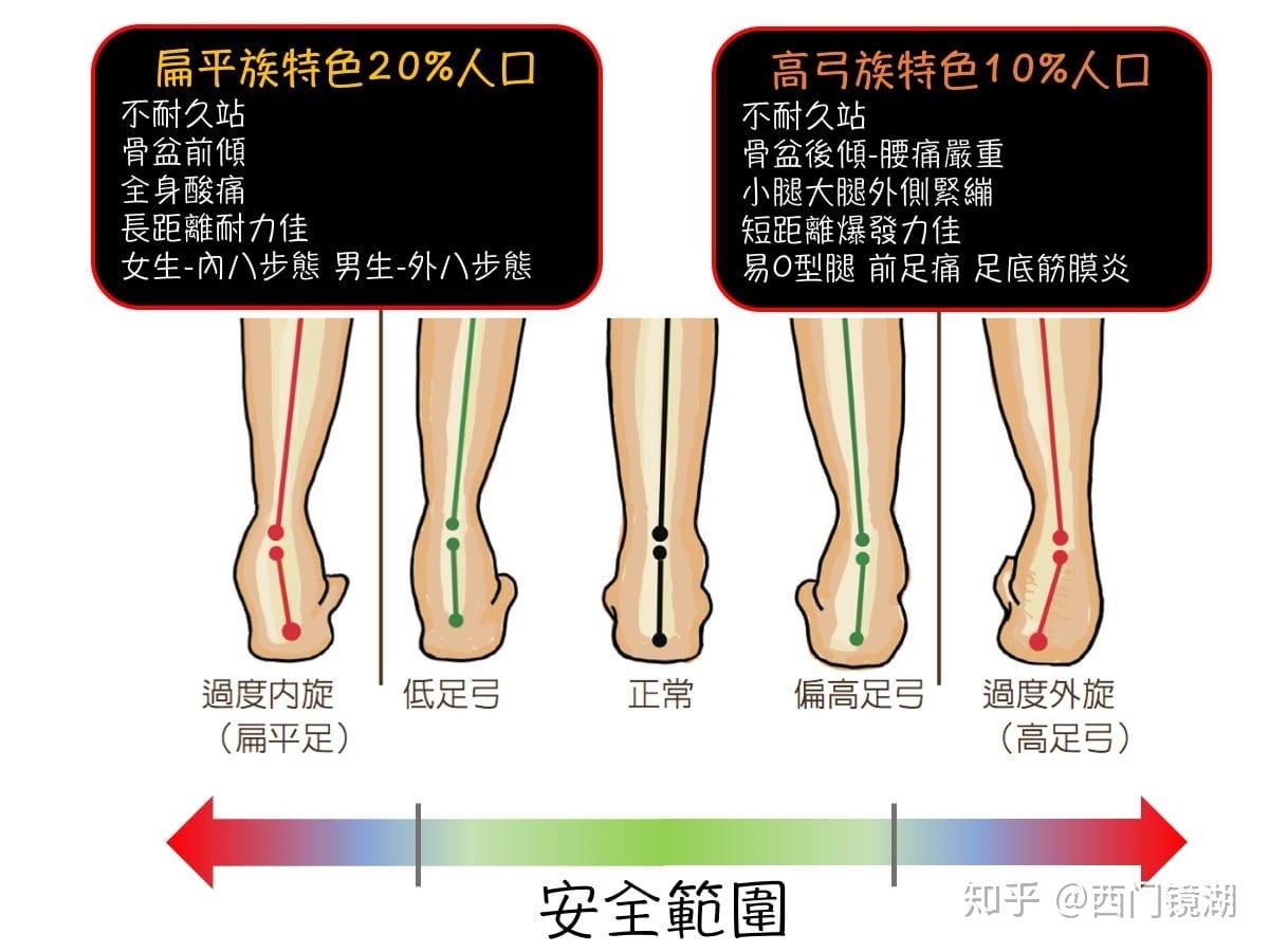X形腿和O形腿可以矫正吗？——下肢力线和Q角 - 知乎