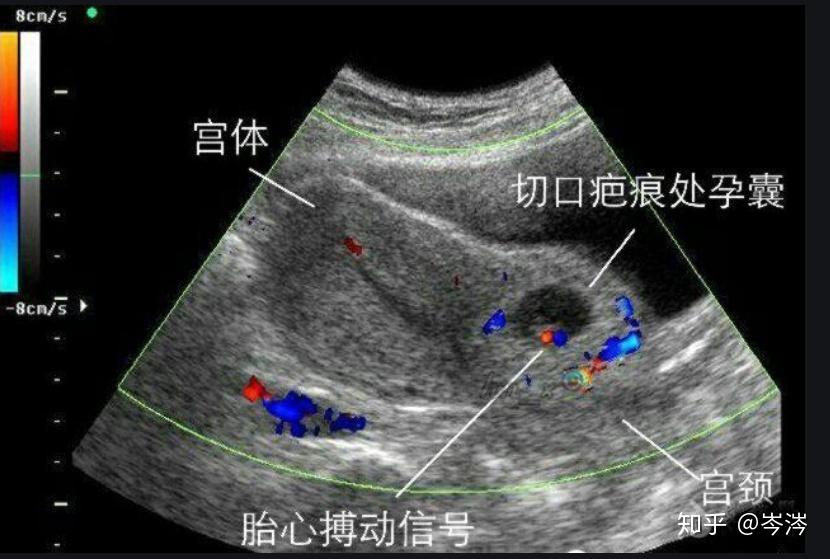 什么是瘢痕妊娠