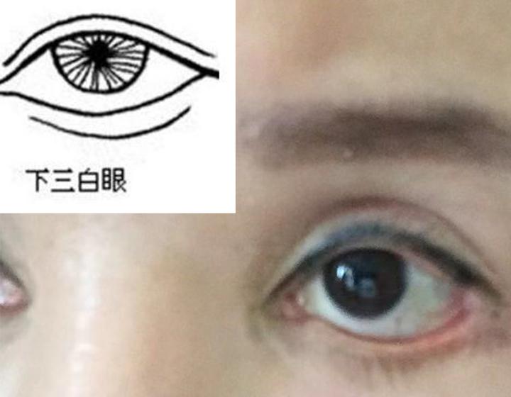 想做眼整形(特别是提肌和下睑下至手术)的要注意了,小心下三白眼(下睑退缩)的先天性与后天性陷阱 - 知乎