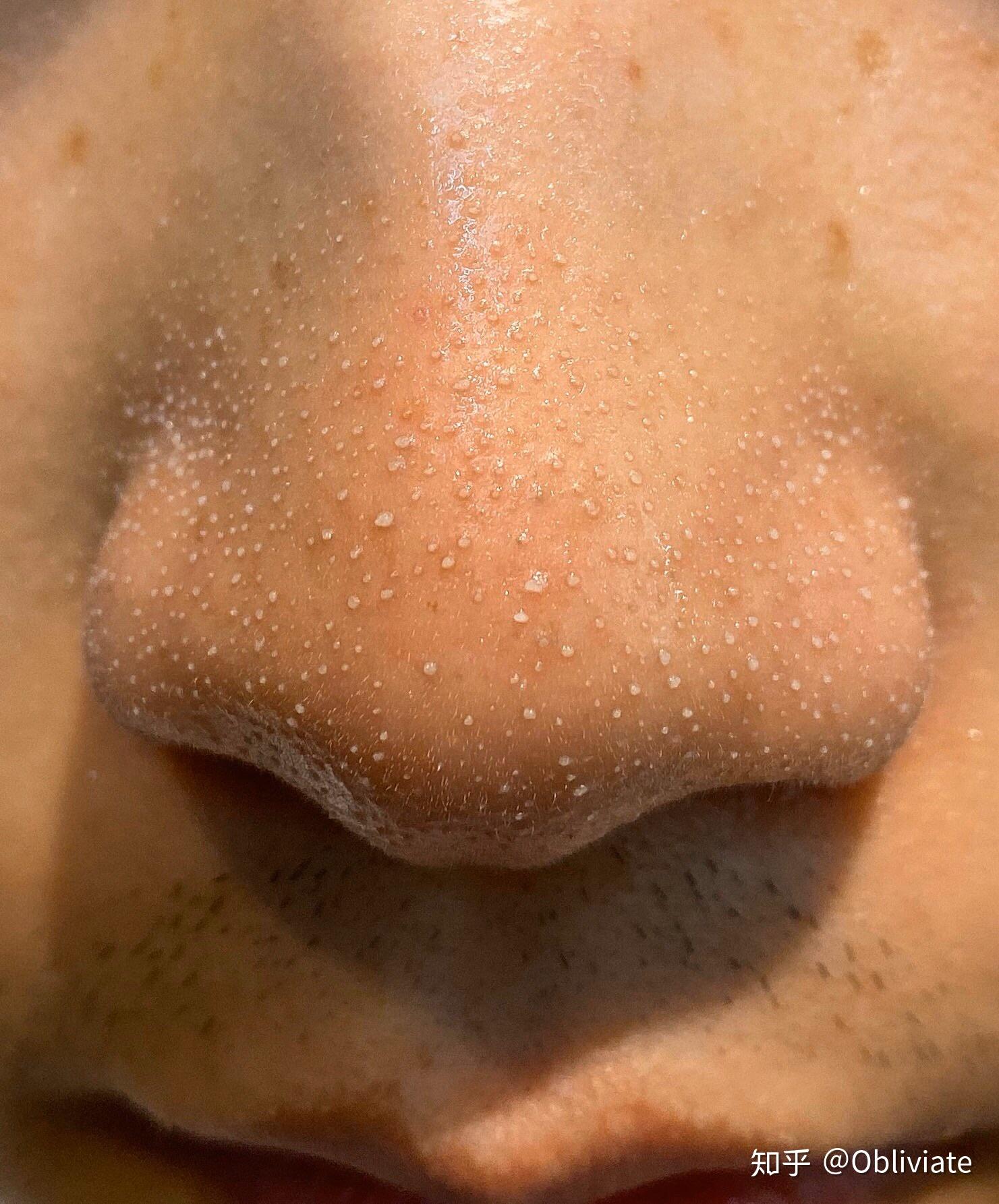 看见男票就忍不住帮他挤黑头怎么办