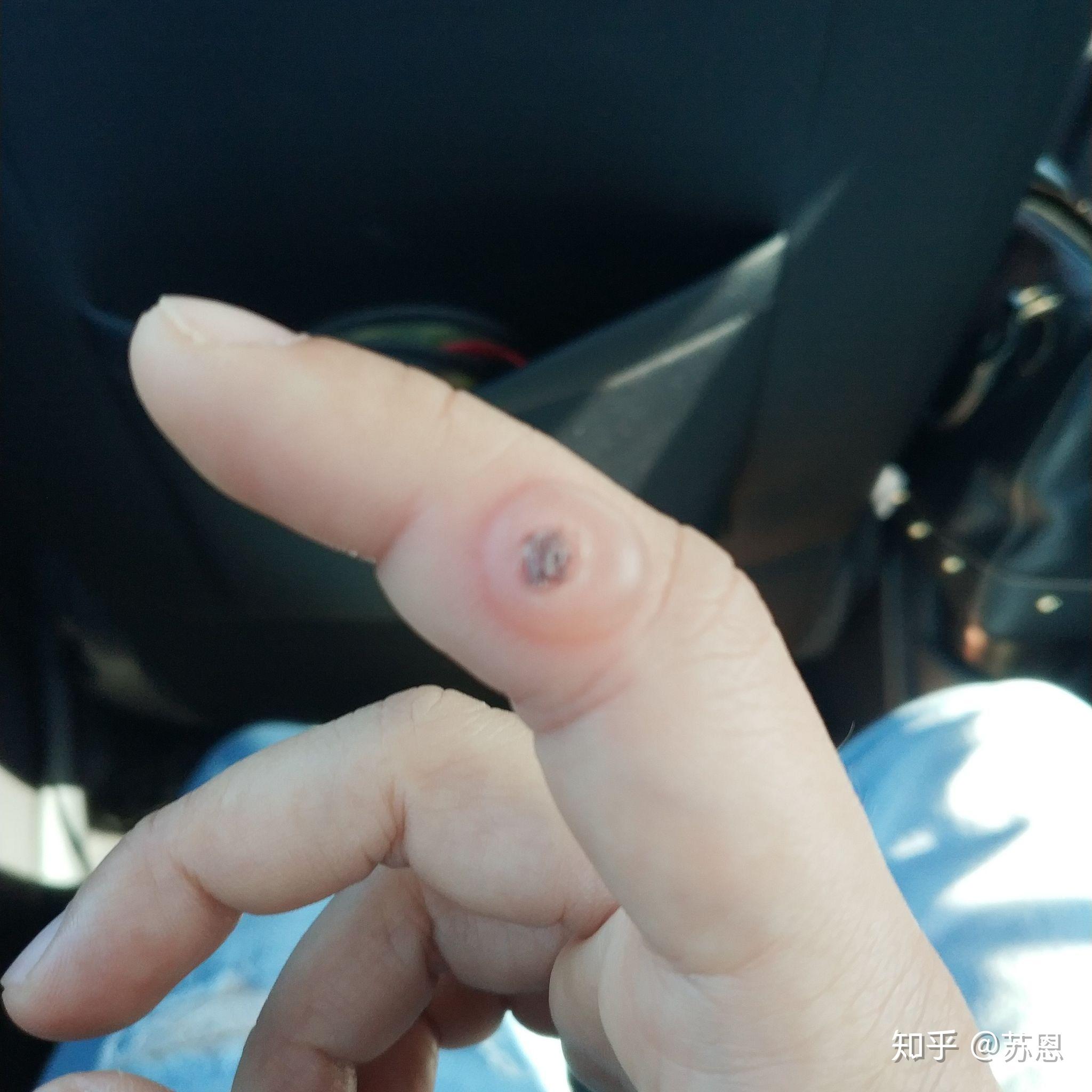 液氮冷冻治疗后手指上出了血泡而且越来越大该怎么办