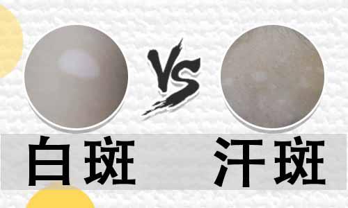 汗斑和白斑都是白癜风么