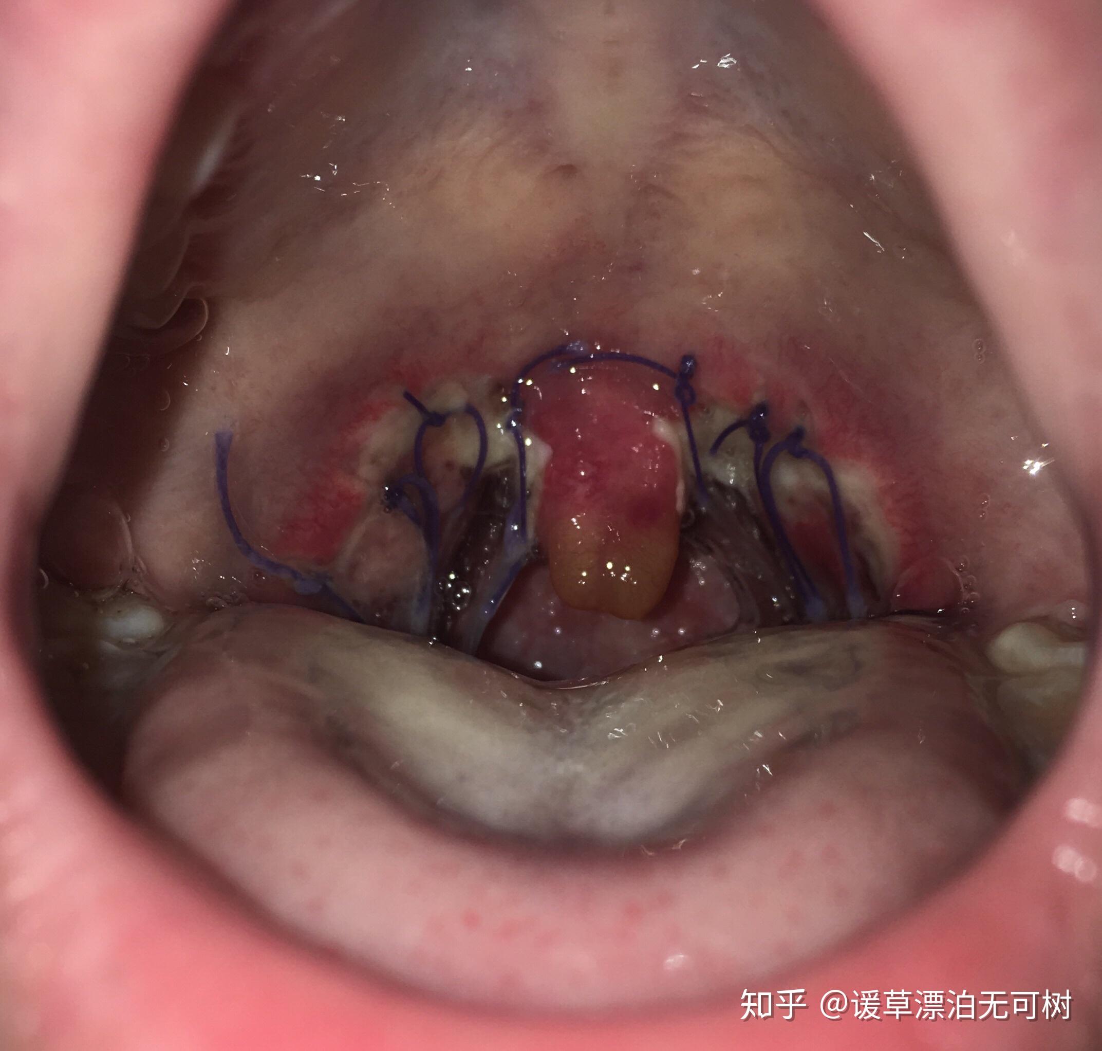 切扁桃体之后是什么感觉? - 知乎