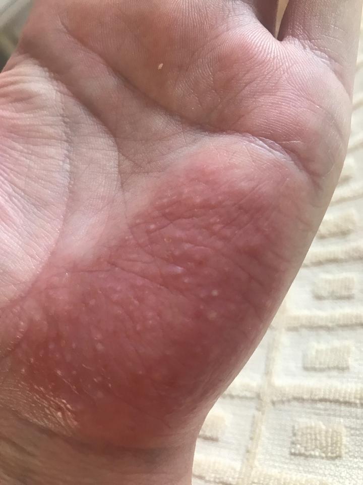 掌跖脓疱病辨证论治之湿热蕴结证