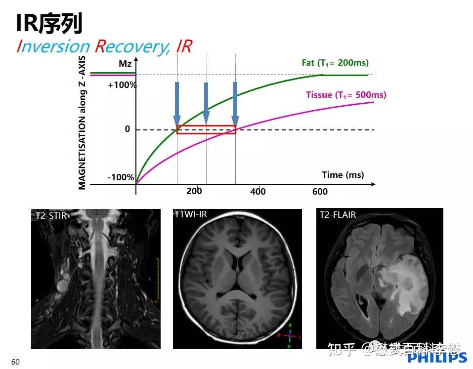 核磁共振t2flair呈高信号是什么意思