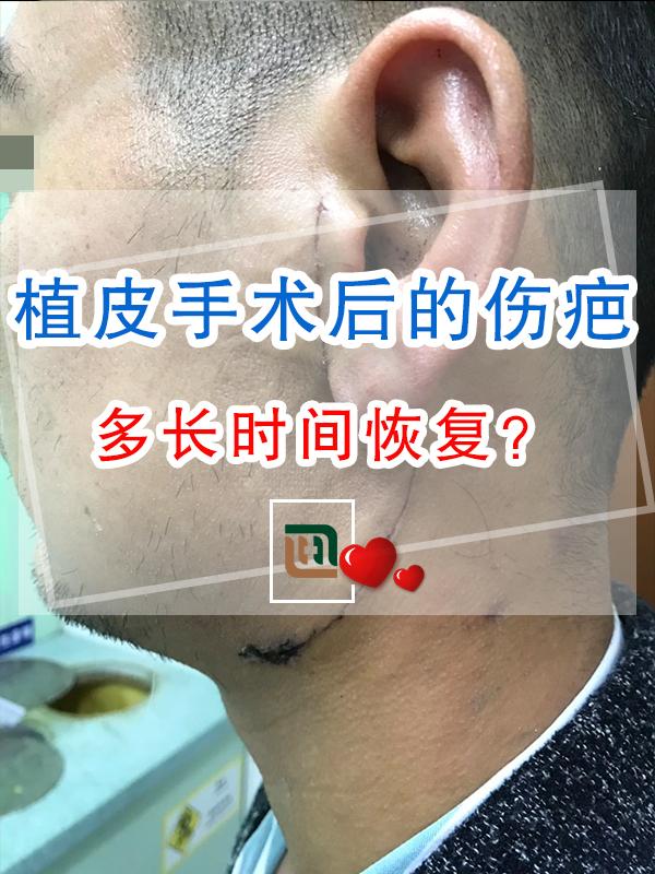 植皮手术后的伤疤多长时间恢复？ - 知乎