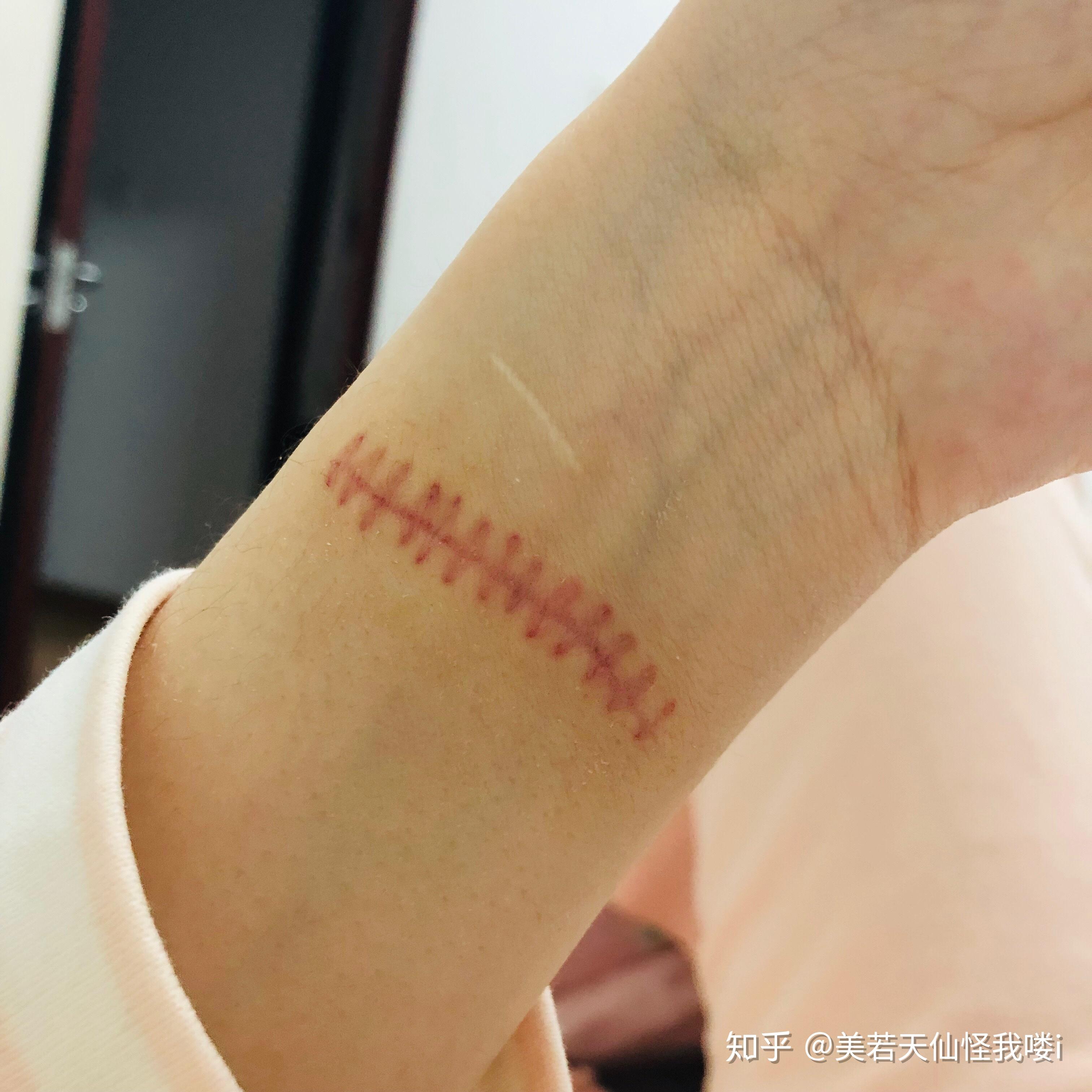 割腕的疤可以去掉吗? - 知乎