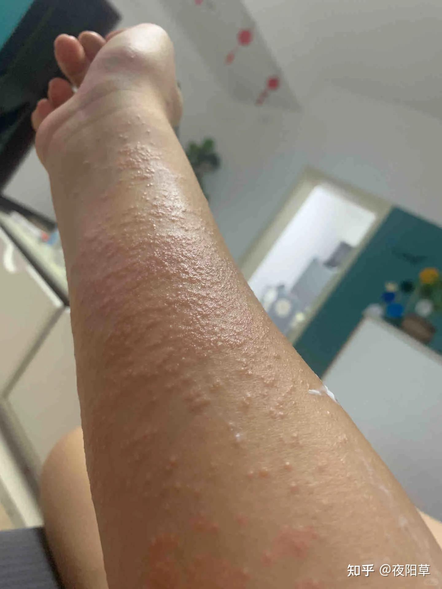 我的湿疹要痒疯了,谁来救救我