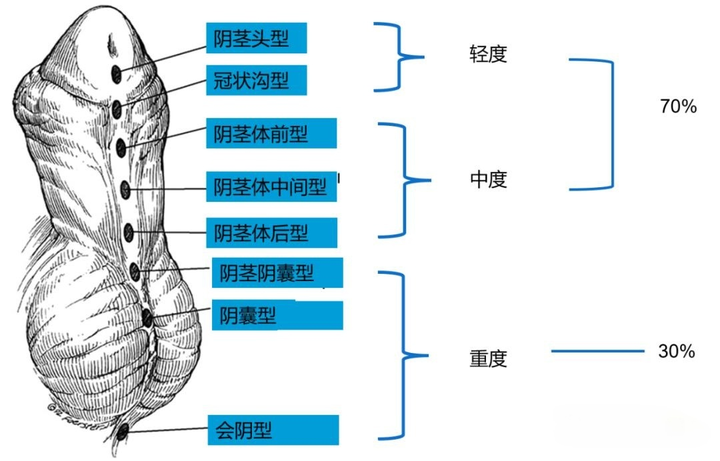 小孩尿道尿道口图片