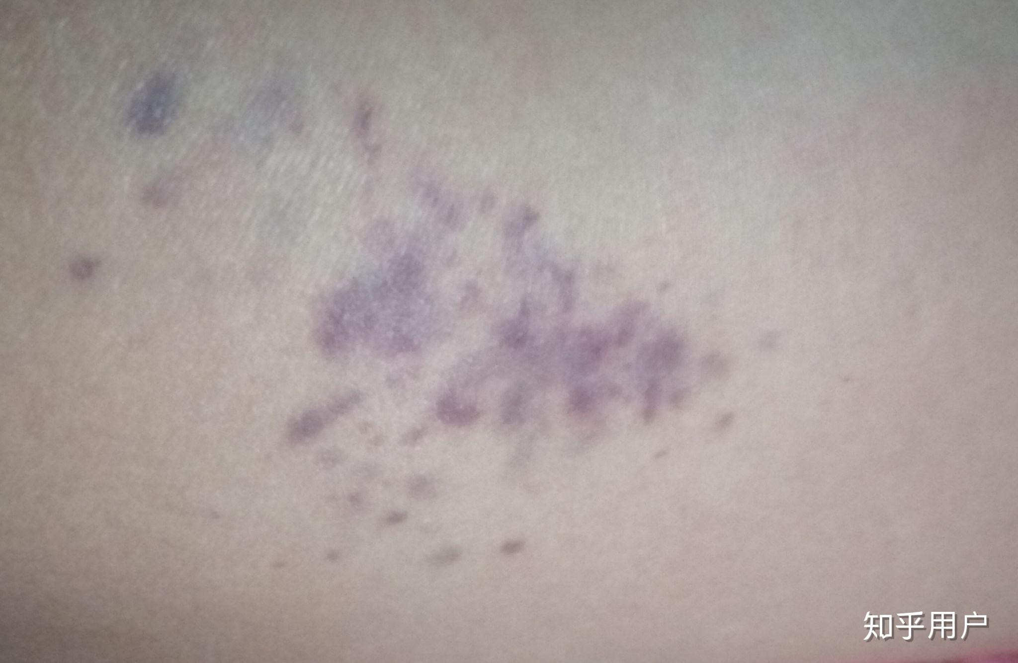 艾滋病早期大腿内紫斑图片