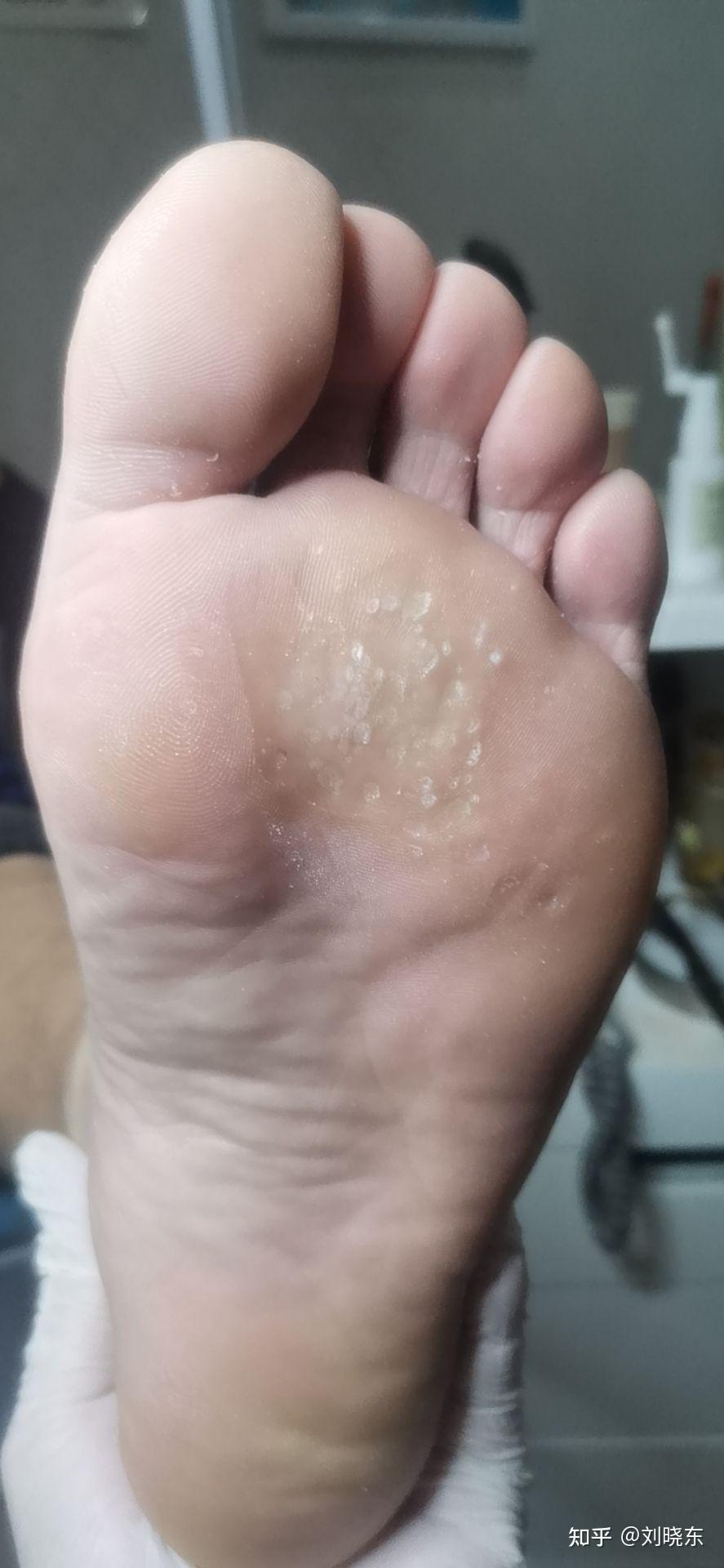 脚底跖疣有去修脚店治疗的吗