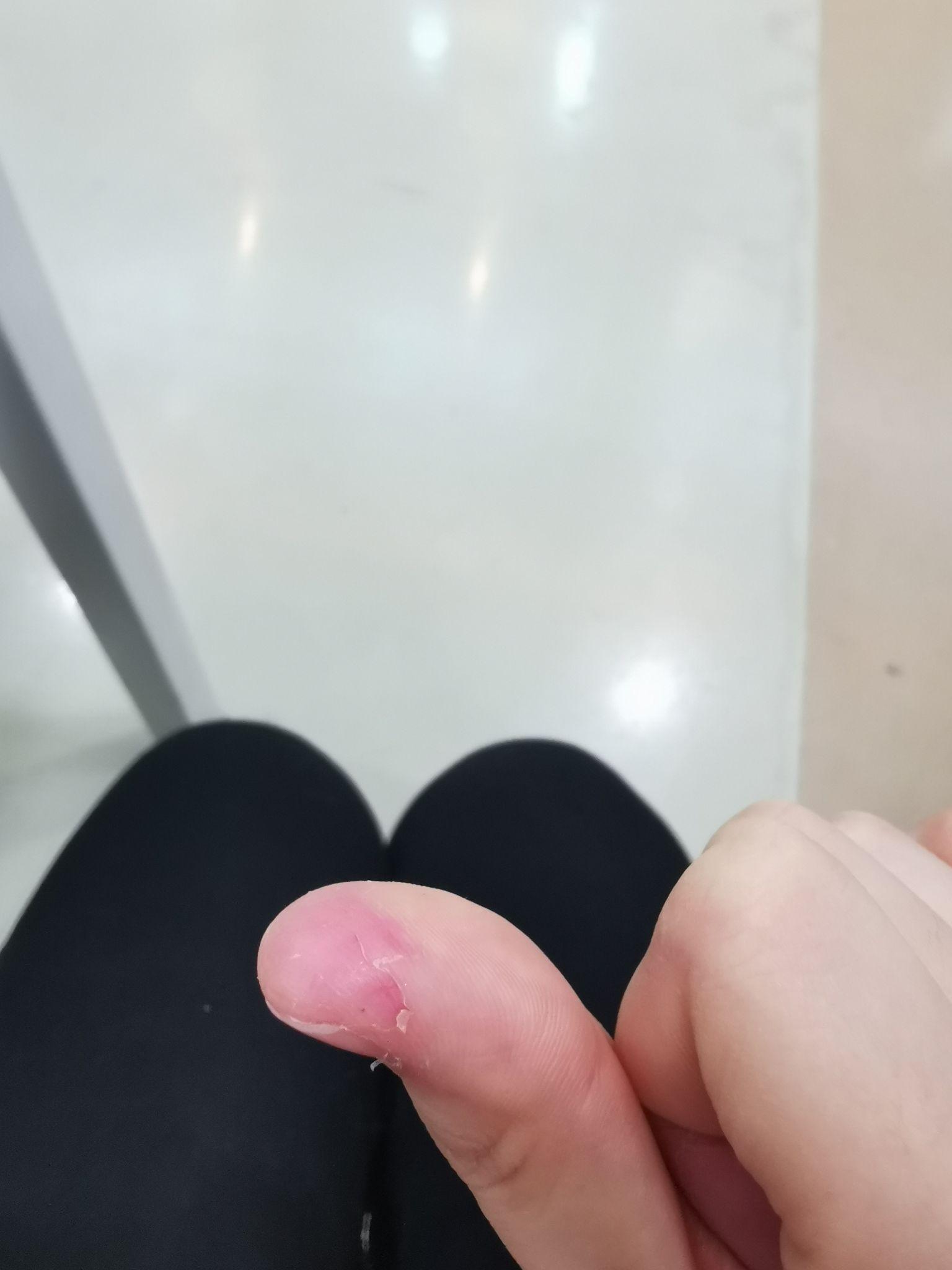 克制不住的抠手指头是心理问题吗?