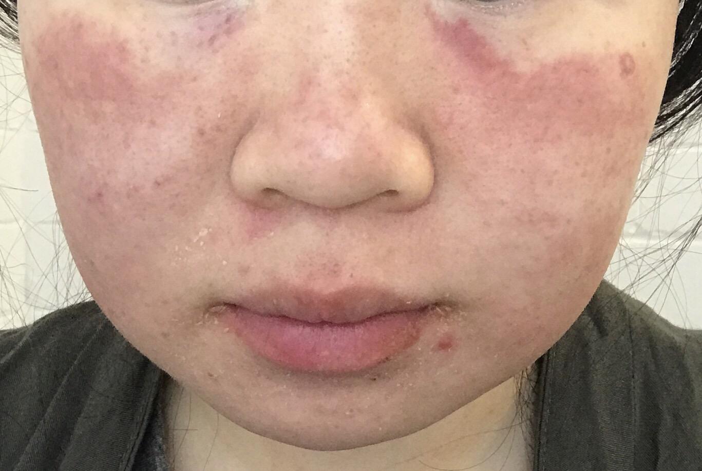脸部过敏的问题如何解决? - 知乎