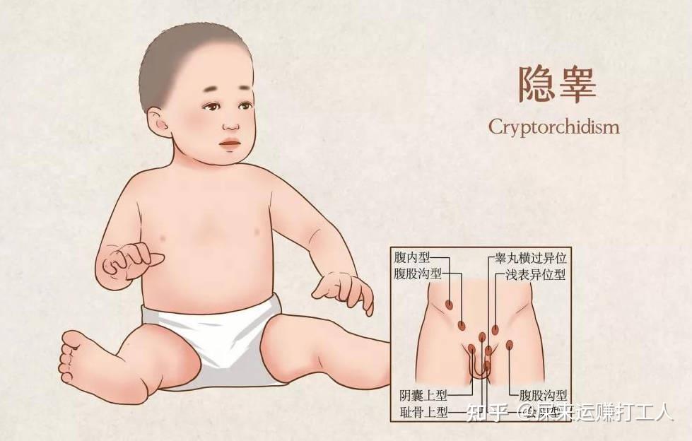 小儿隐睾的原因是什么?