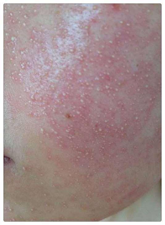 修复激素脸需要排毒吗