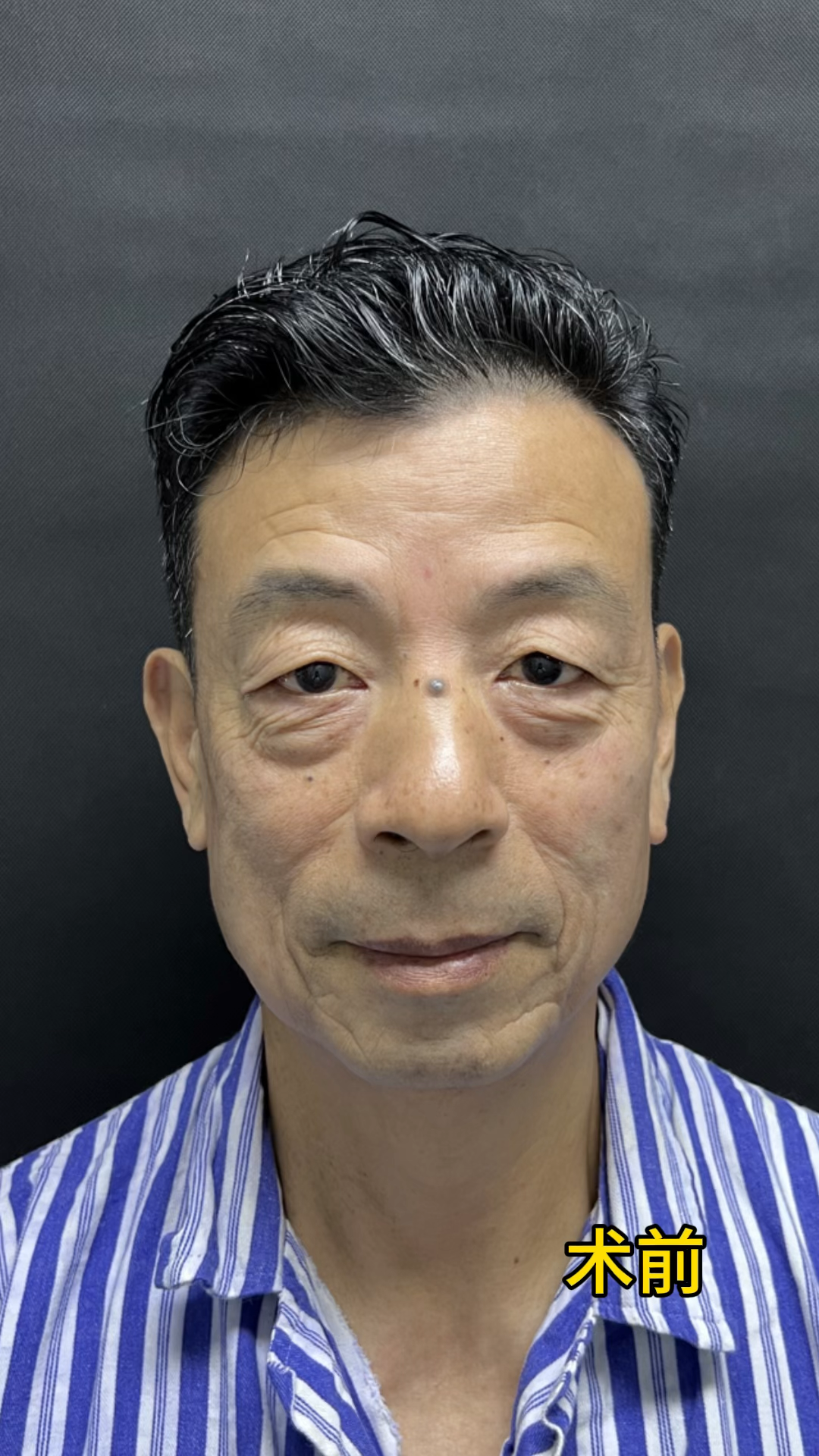 眼皮下垂怎么才能提上去?