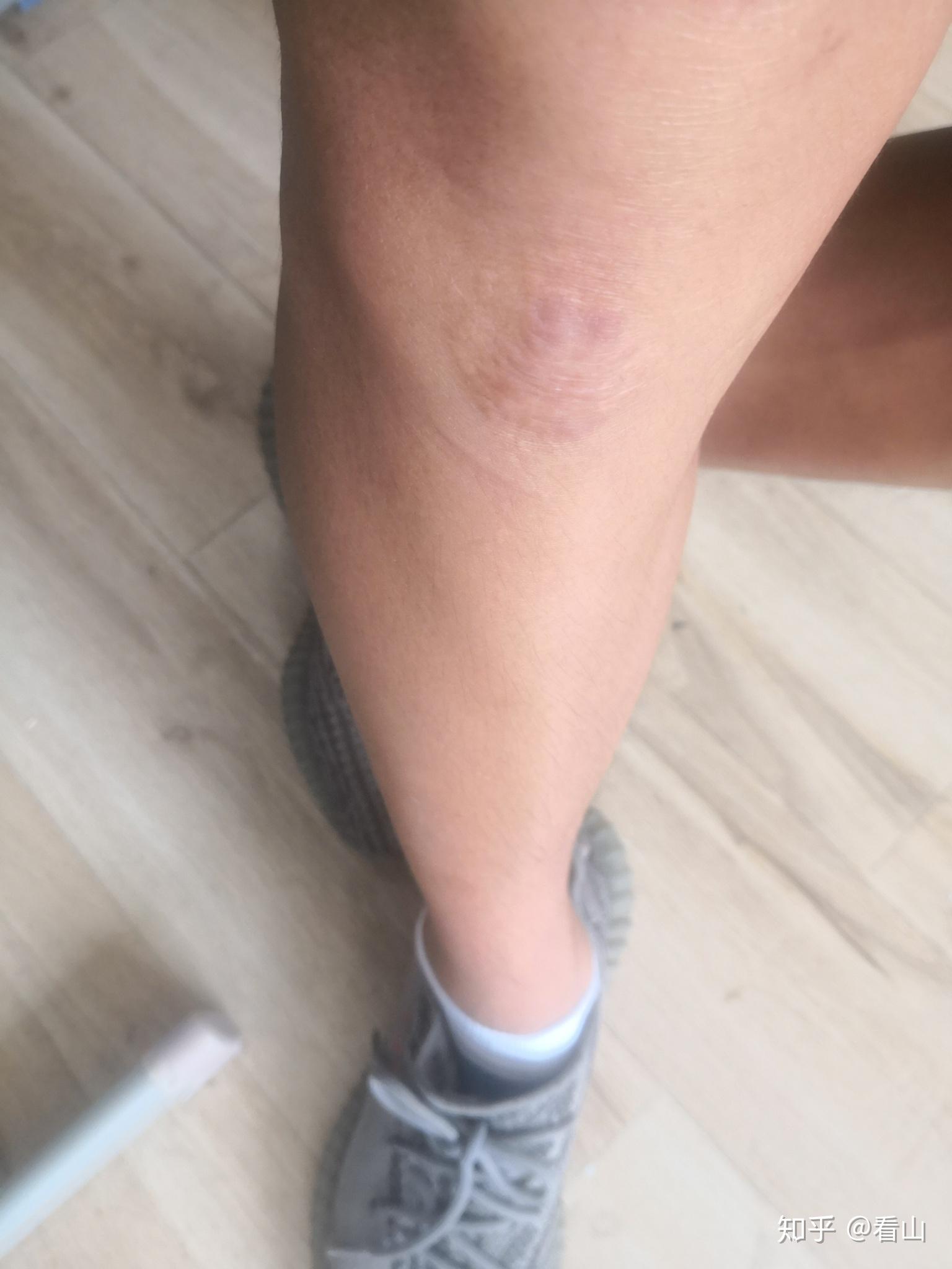 为什么每个伤口痊愈后都会留疤而且鼓起来一块肉有时候充血那样的红
