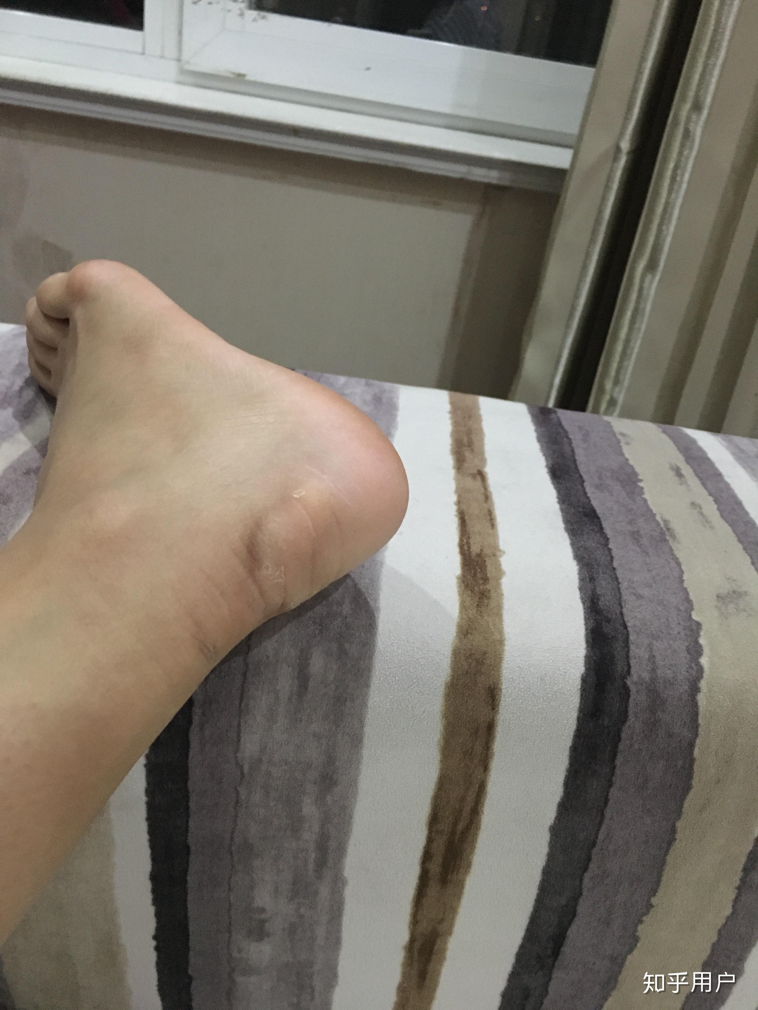 没有脚后跟是一种怎样的体验?怎么解决? - 知乎