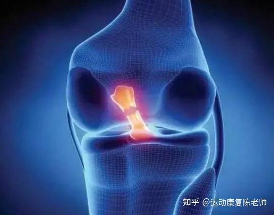 膝盖前十字韧带重建选择自身还是人工? - 知乎