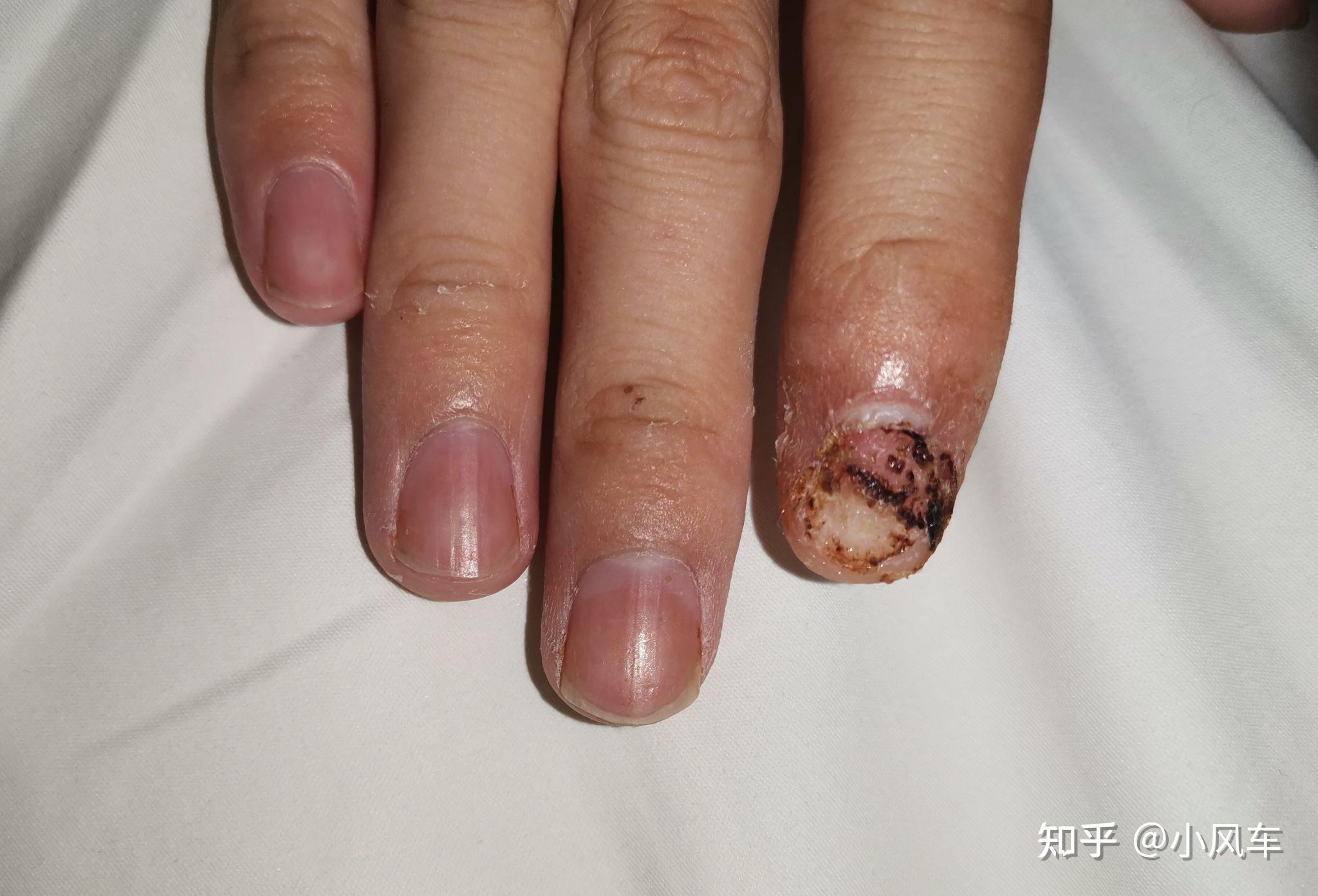 指甲盖掉了会重新长出来吗,需要多久? - 知乎