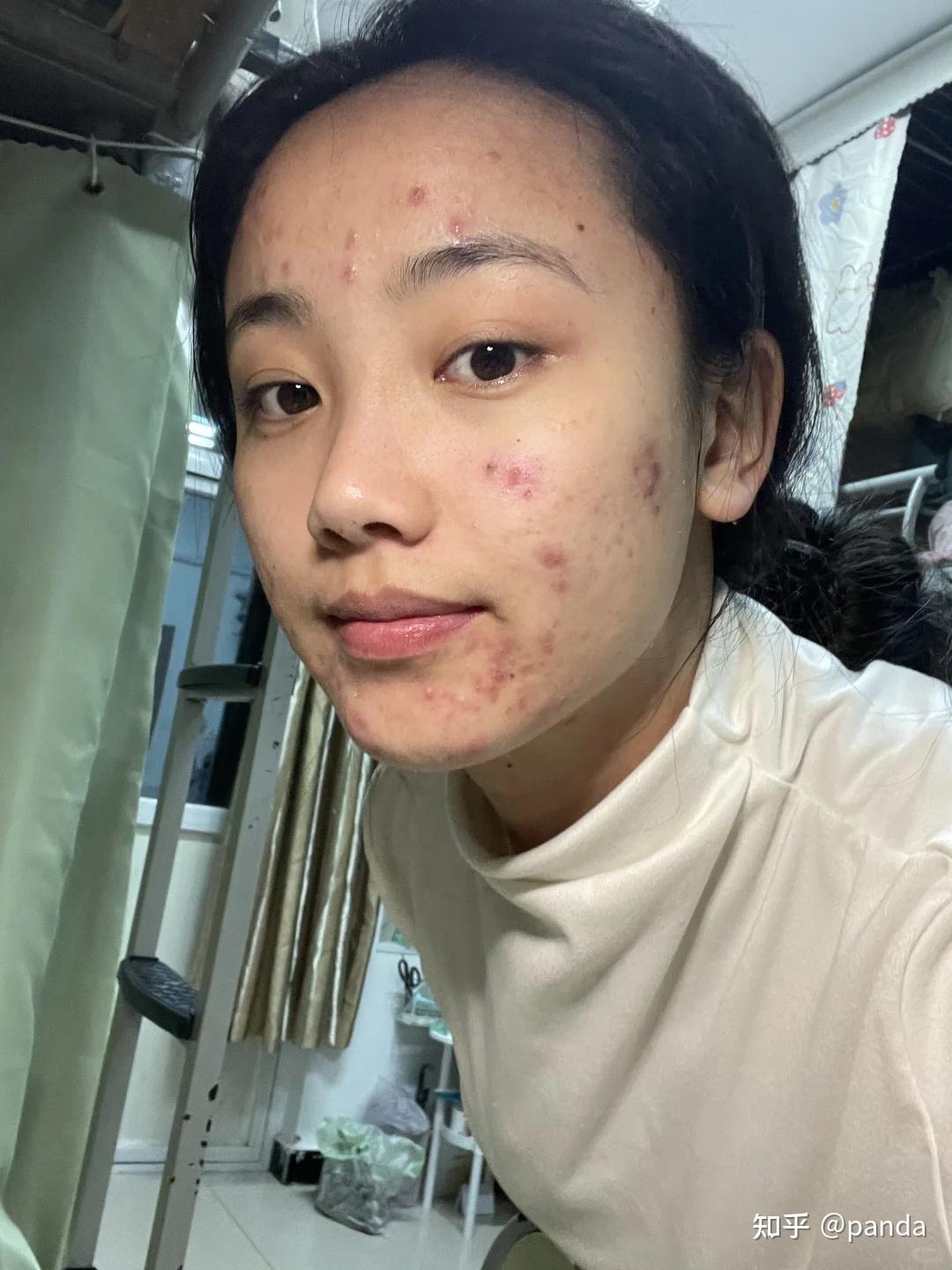 为什么满脸的痘痘去不掉,还总是反反复复的长?