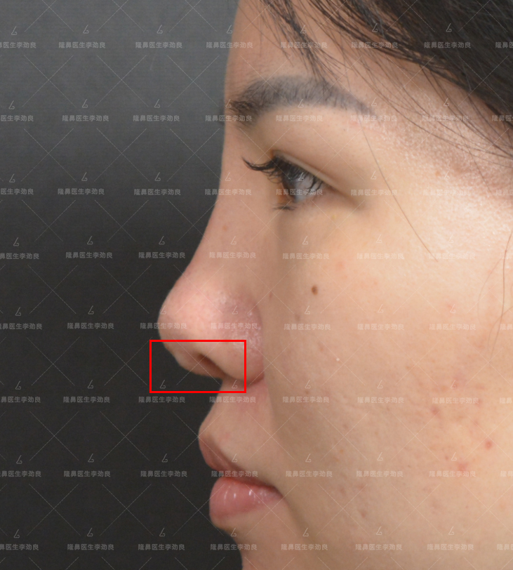 为什么假体放在鼻尖有穿出的风险? - 知乎