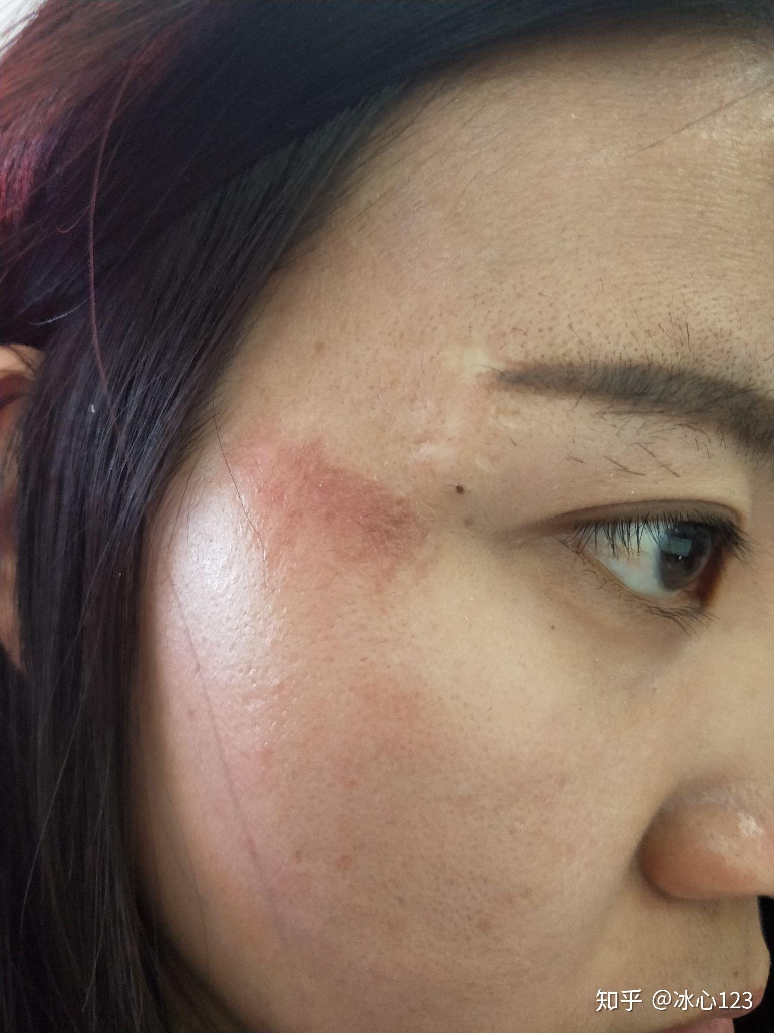 脸部擦伤如图,请问如何恢复?