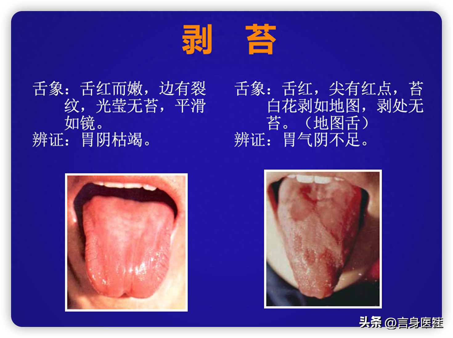 正常的舌苔是怎样的? - 知乎