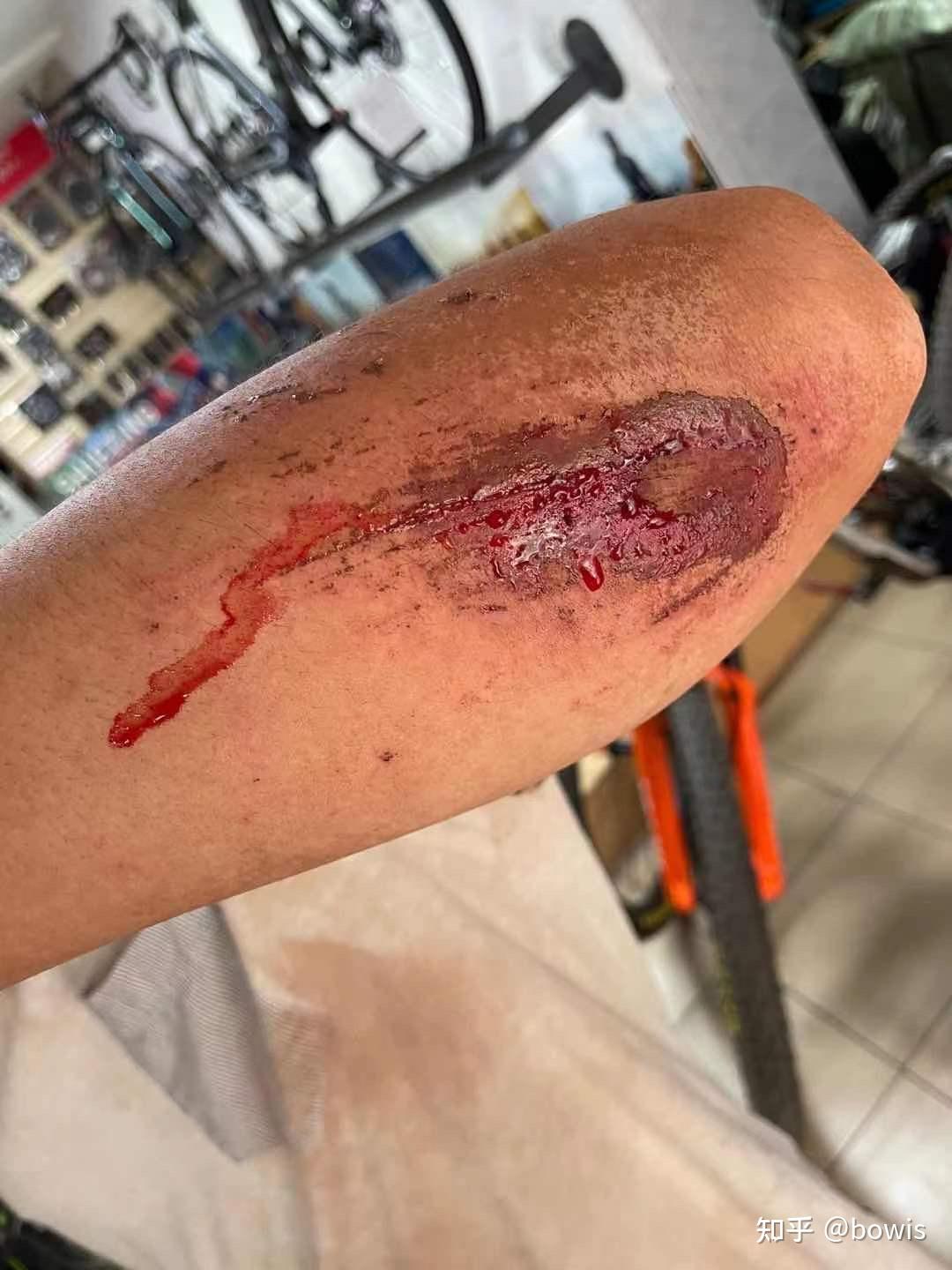 骑车摔倒擦伤怎么快速修复啊