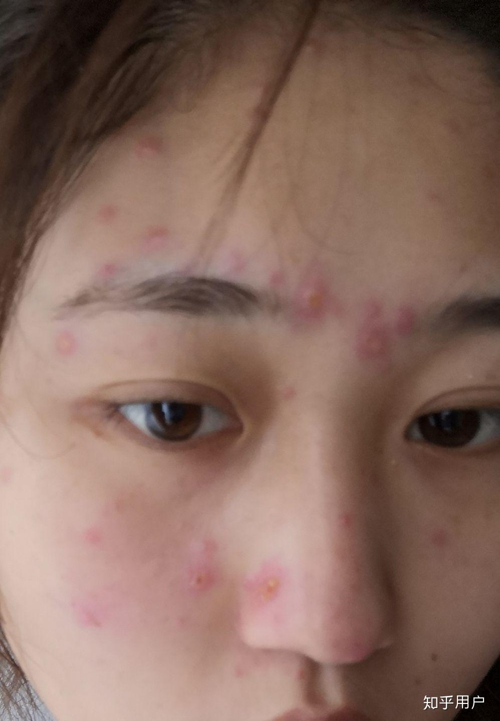 成人长水痘是什么样的经历
