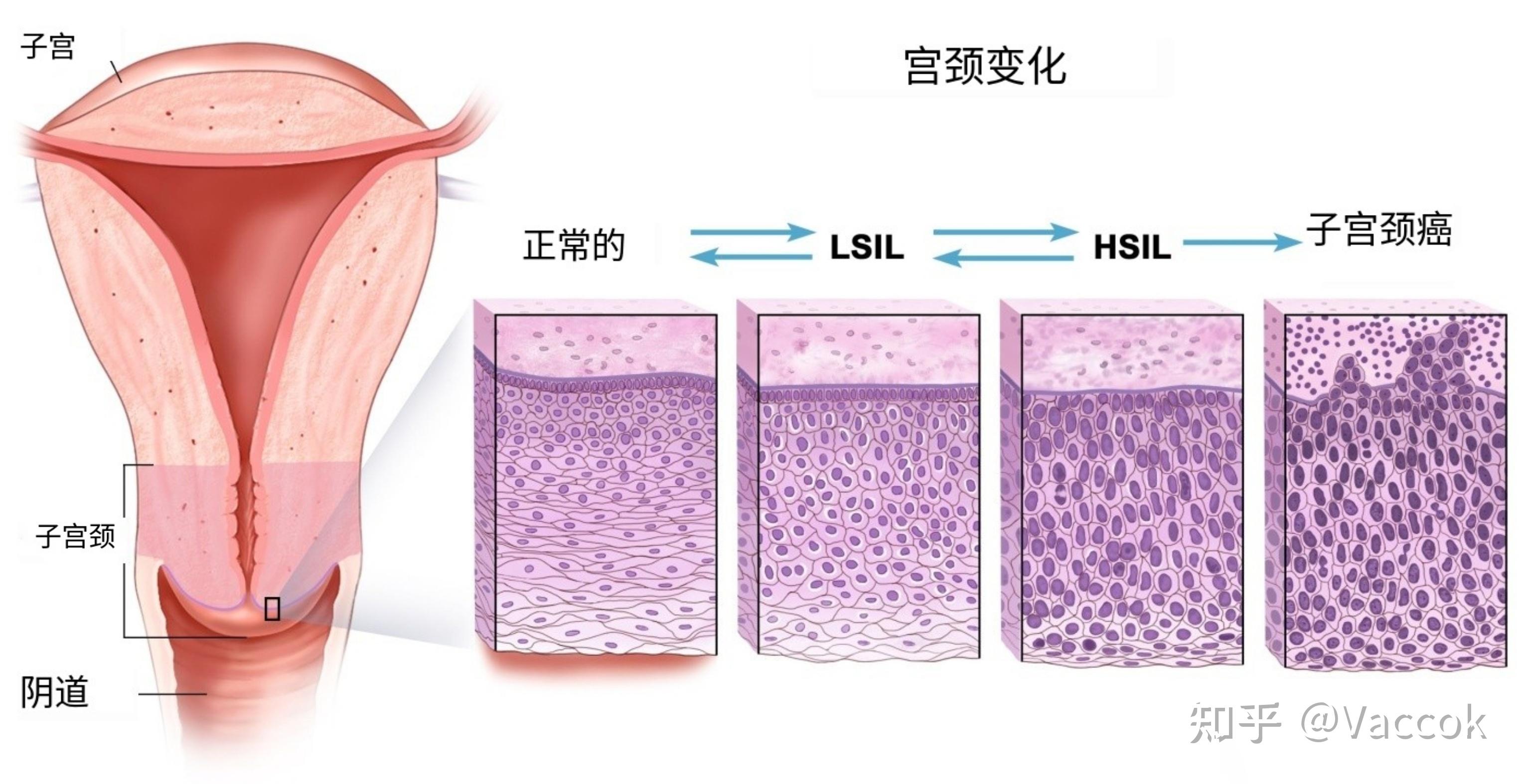 宫颈病变图片 图谱图片