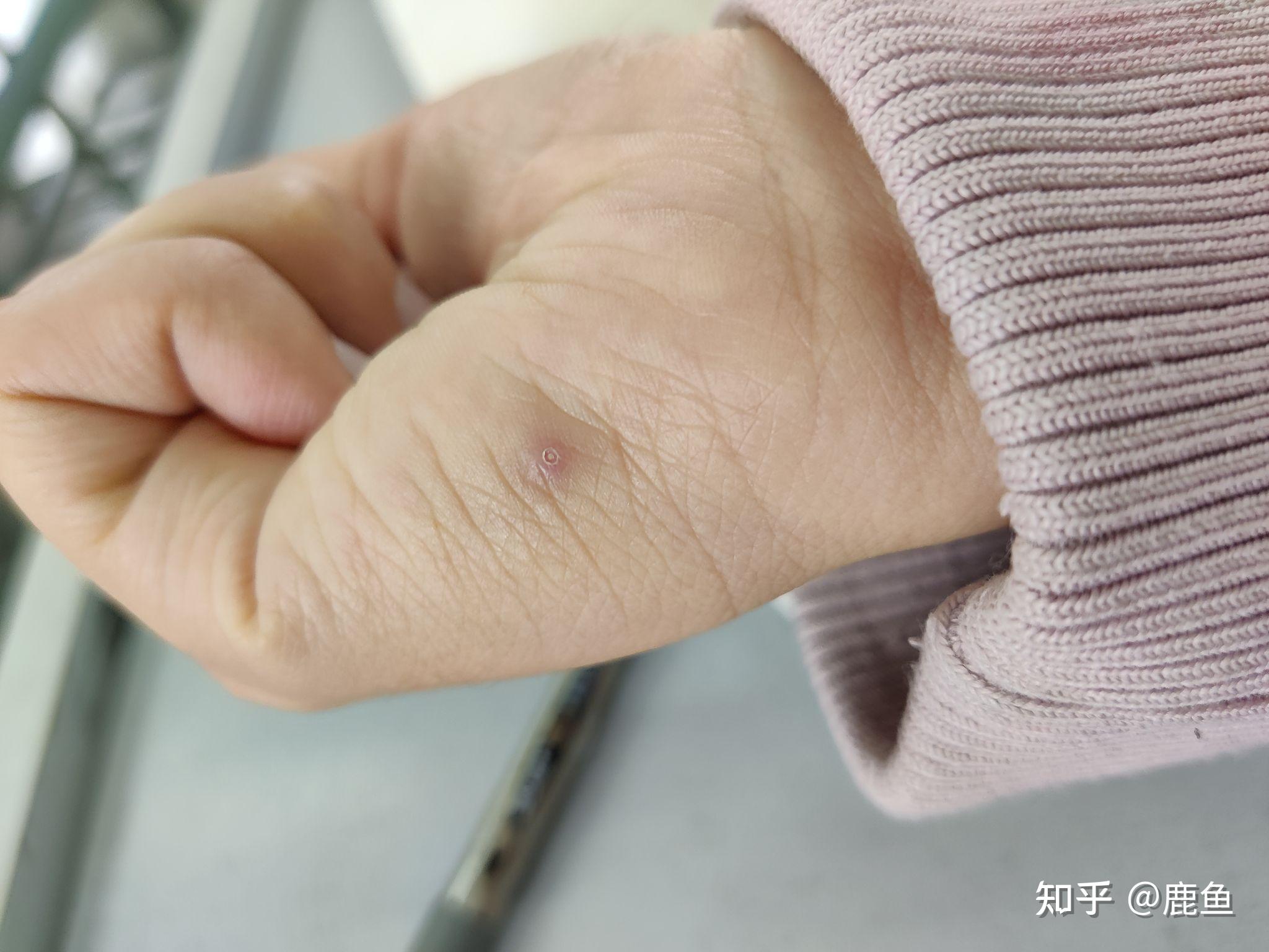 手扎刺如果不挑出来会有怎样的后果? - 知乎