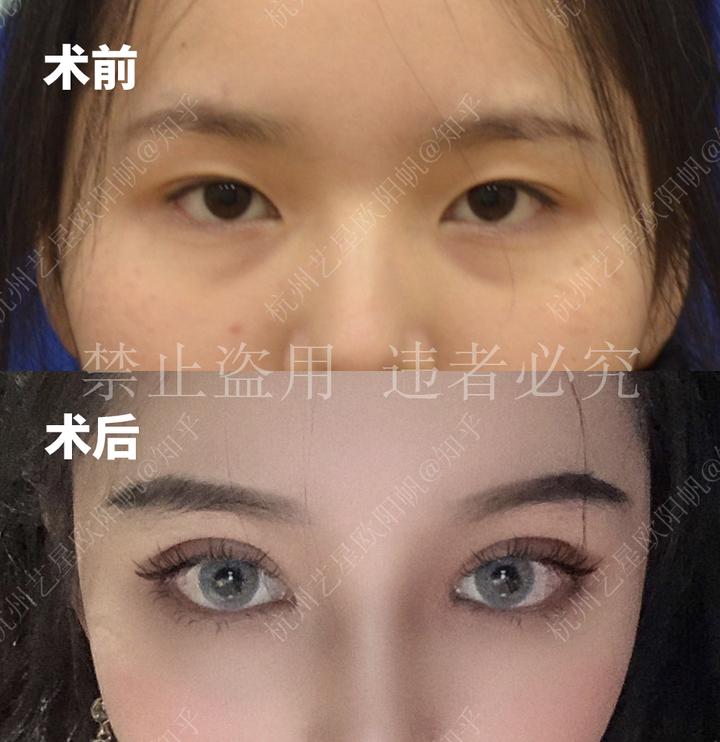 内双割双眼皮怎么做自然?杭州内双割双眼皮怎么选医生? - 知乎
