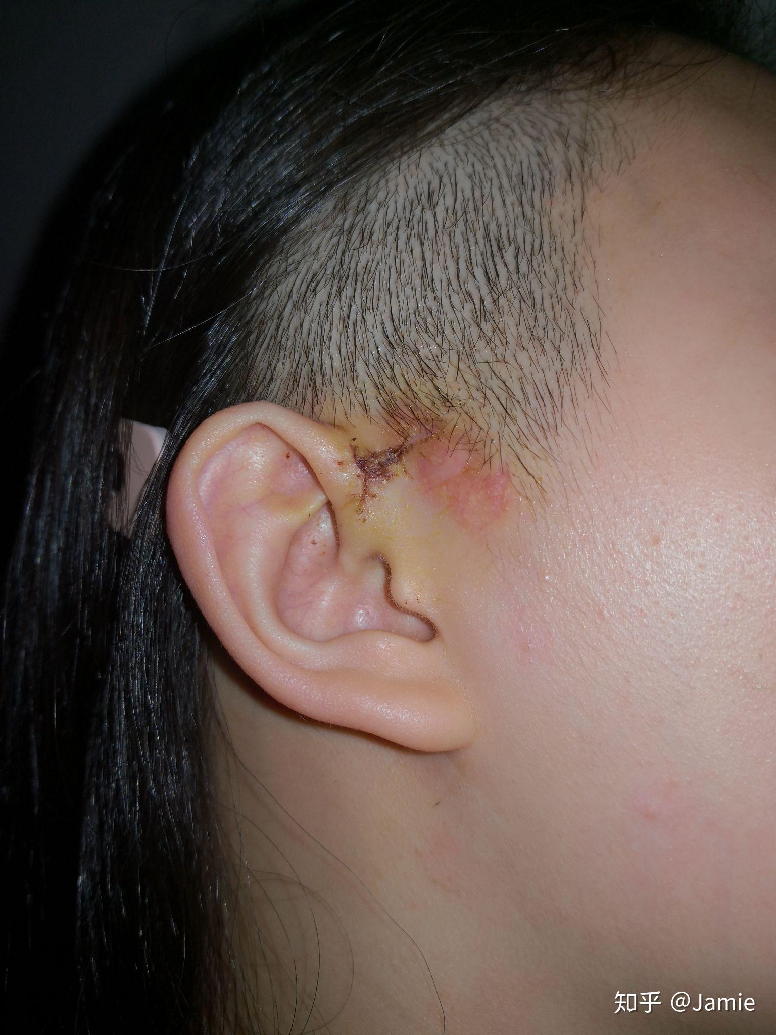 患有先天性耳前瘘管是一种怎样的体验? - 知乎