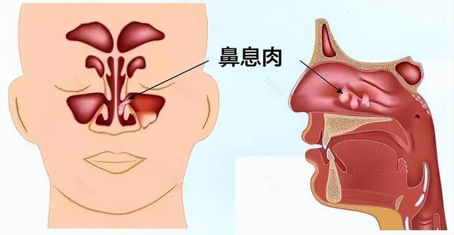 为什么会长鼻息肉图片