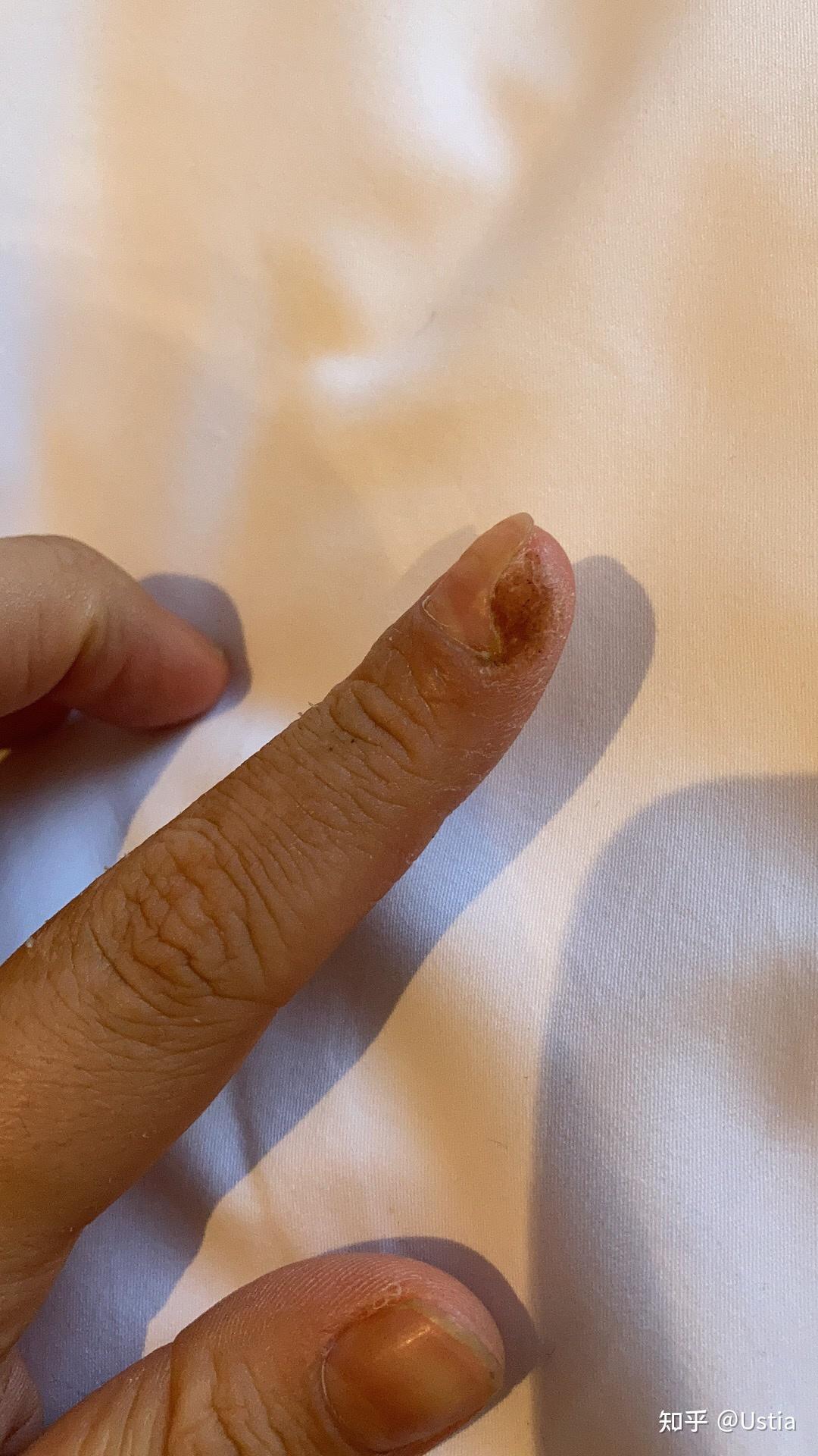 各位大神鄙人手残手指甲旁边长了死皮用指甲刀剪的时候把一些肉也剪了